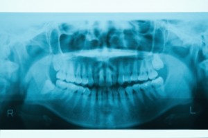 radiografia dental