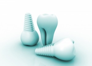 el-implante-dental