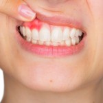 Luján Navas - Dentista de Confianza - Qué es la gingivitis