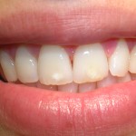Doctora Luján Navas - Dentista de Confianza en Leganés - Encías inflamadas