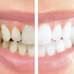 Luján Navas - Dentista de Confianza en Leganés - Manchas en los dientes