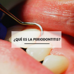 ¿Qué es la periodontitis?