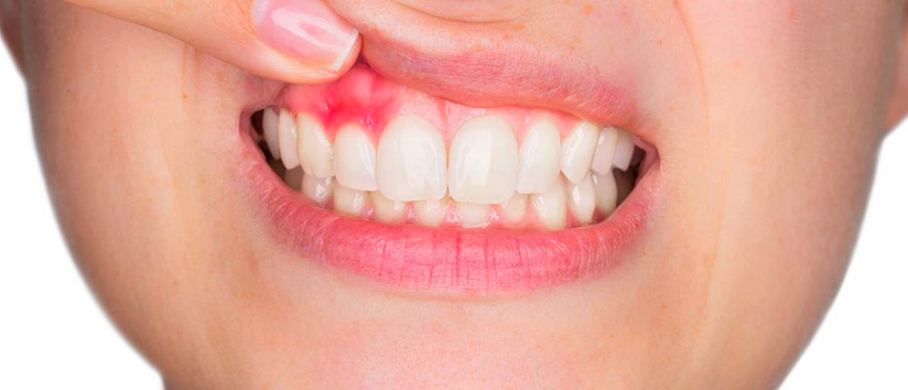 gingivitis- mantener boca sana