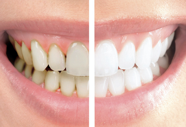 Luján Navas - Dentista de Confianza en Leganés - Manchas en los dientes