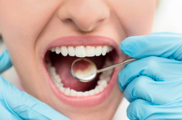 periodontitis y cáncer esófago