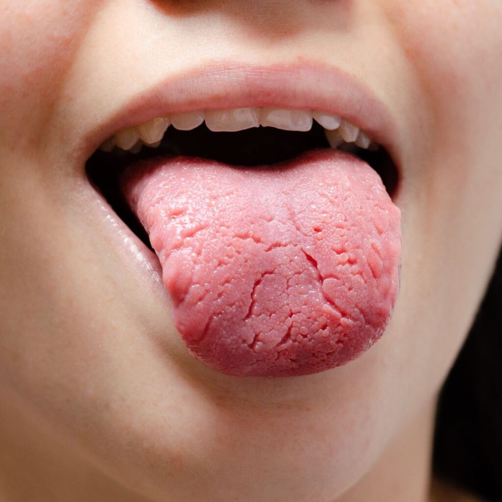lengua podría hacerte padecer enfermedad de las encías